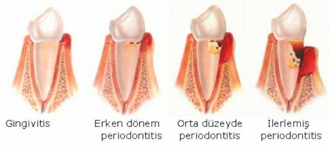 Dişeti Hastalıkları ve Diş Eti Çekilmesi