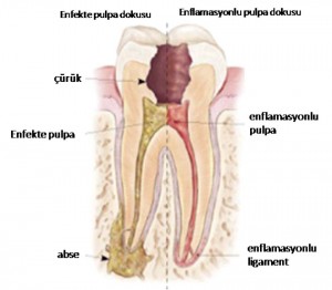 Kanal Tedavisi-Endodonti