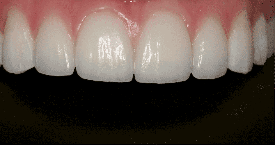 porselen diş modelleri